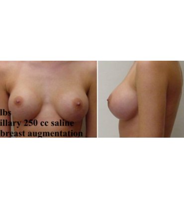 Breast Implant Size After